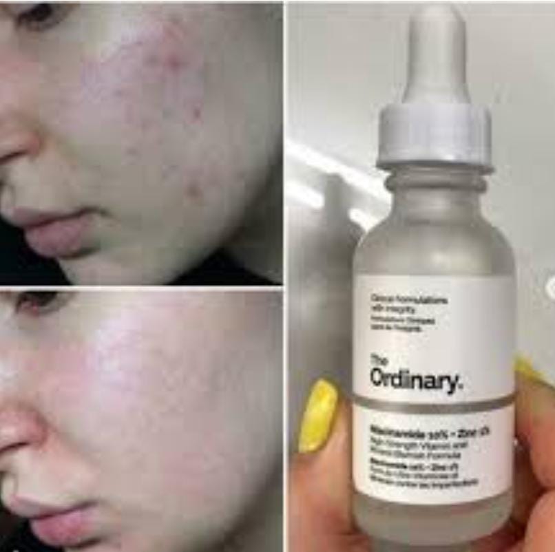 The Ordinary Niacinamide 10% + Zinc 1%, Smoothing Serum for Blemish-Prone Skin